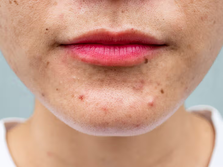 Does Silica Help With Acne Breakouts?