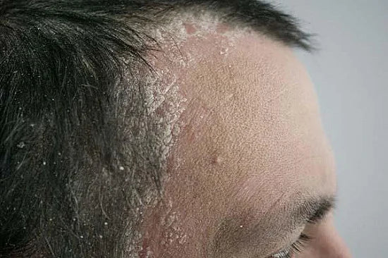 Scalp Health Basics: Dandruff, Dryness, and Supportive Habits